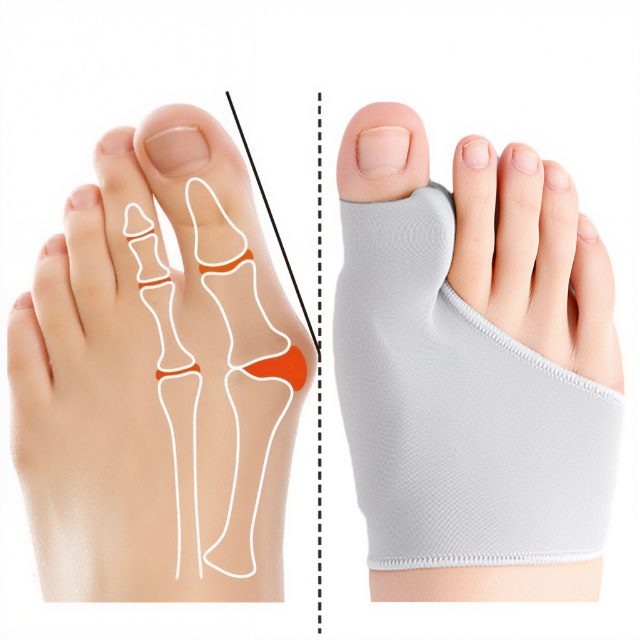 "Correcteur d'orteils en silicone pour soulagement hallux valgus, discret et confortable, idéal peaux sensibles."